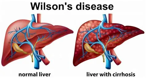 विल्सन रोग (Wilson's Disease - तांबा जमा होना)
