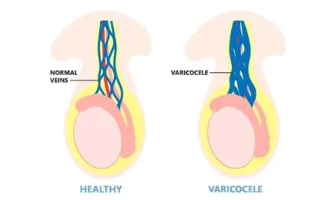 वेरिकोसेल (Varicocele)