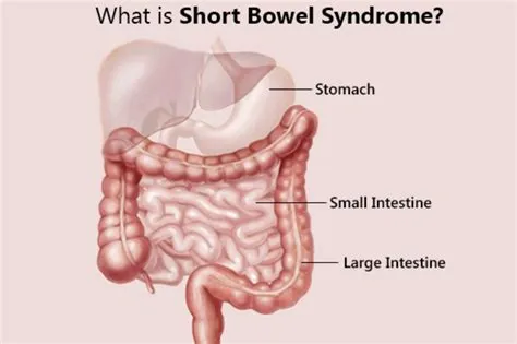 शॉर्ट बाउल सिंड्रोम (Short Bowel Syndrome)