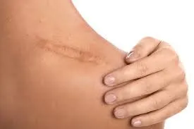 सर्जरी के बाद स्कार टिश्यू (Scar Tissue) को मुलायम बनाने के लिए मसाज तकनीक