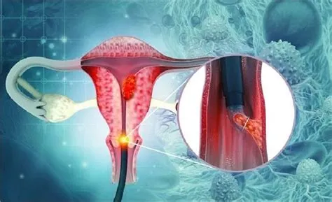 सर्वाइकल कैंसर (Cervical Cancer)