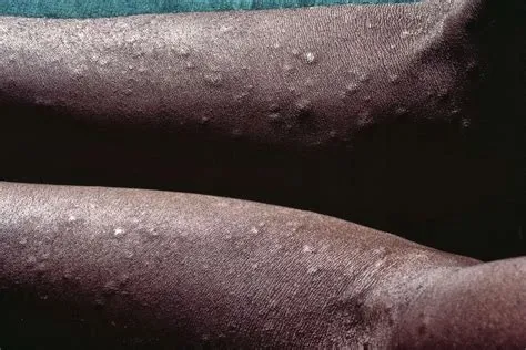 सिफलिस (Syphilis)