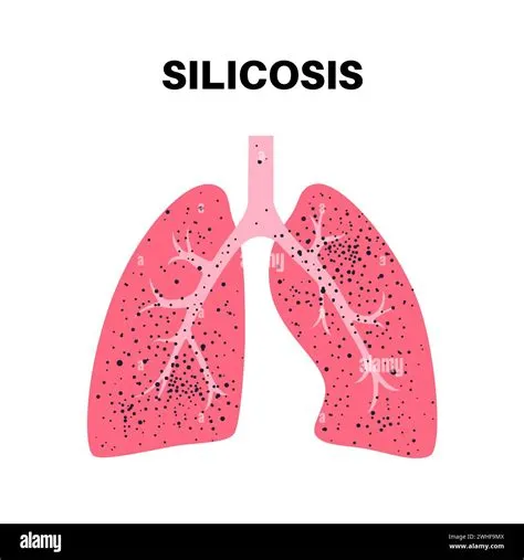 सिलिकोसिस (Silicosis)