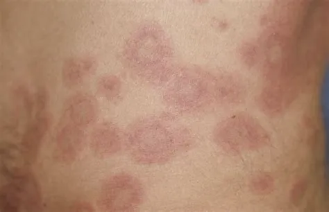 सिस्टमिक ल्यूपस एरिथेमेटोसस (SLE / Lupus / ल्यूपस)