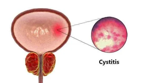 सिस्टाइटिस (Cystitis - मूत्राशय की सूजन)
