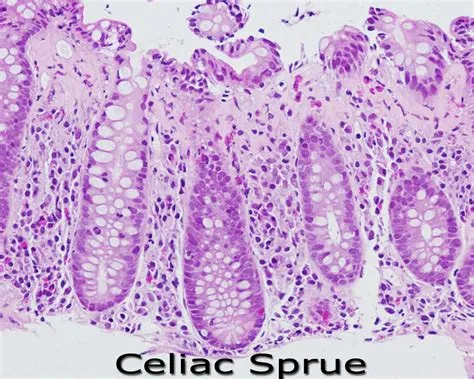 सीलिएक स्प्रू (Celiac Sprue)