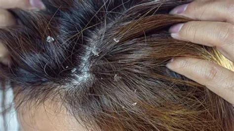 सेबोरीक डर्मेटाइटिस (Seborrheic Dermatitis)