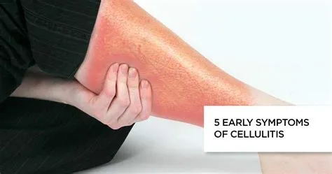 सेल्युलाइटिस (Cellulitis)