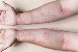 सोरायटिक अर्थराइटिस (Psoriatic Arthritis)