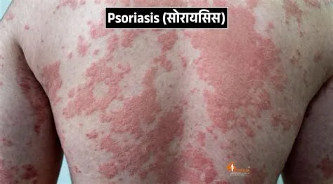 सोरायसिस (Psoriasis)