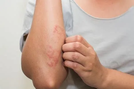 स्केबीज (Scabies / खाज-खुजली)