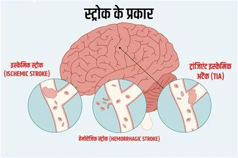 स्ट्रोक (Stroke / लकवा या पक्षाघात)