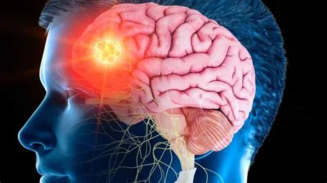 स्ट्रोक के बाद न्यूरोप्लास्टिसिटी (Neuroplasticity) बढ़ाने के लिए दोहराव वाले व्यायाम