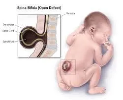 स्पाइना बिफिडा (Spina Bifida - रीढ़ की हड्डी का दोष)