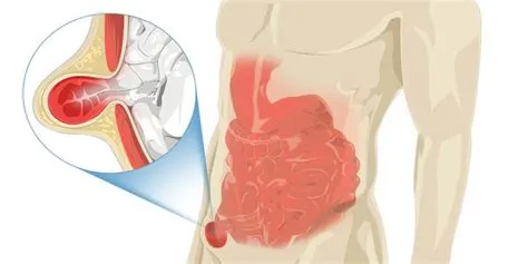 हर्निया (Hernia)