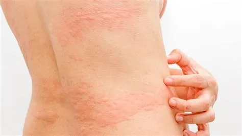 हाइव्स (Hives / अर्टिकेरिया / पित्ती उछलना)