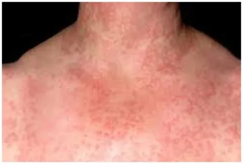 एक्वाजेनिक अर्टिकेरिया (Aquagenic Urticaria - पानी के संपर्क से त्वचा में एलर्जी)