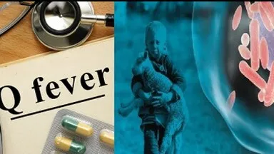 क्यू फीवर (Q Fever)