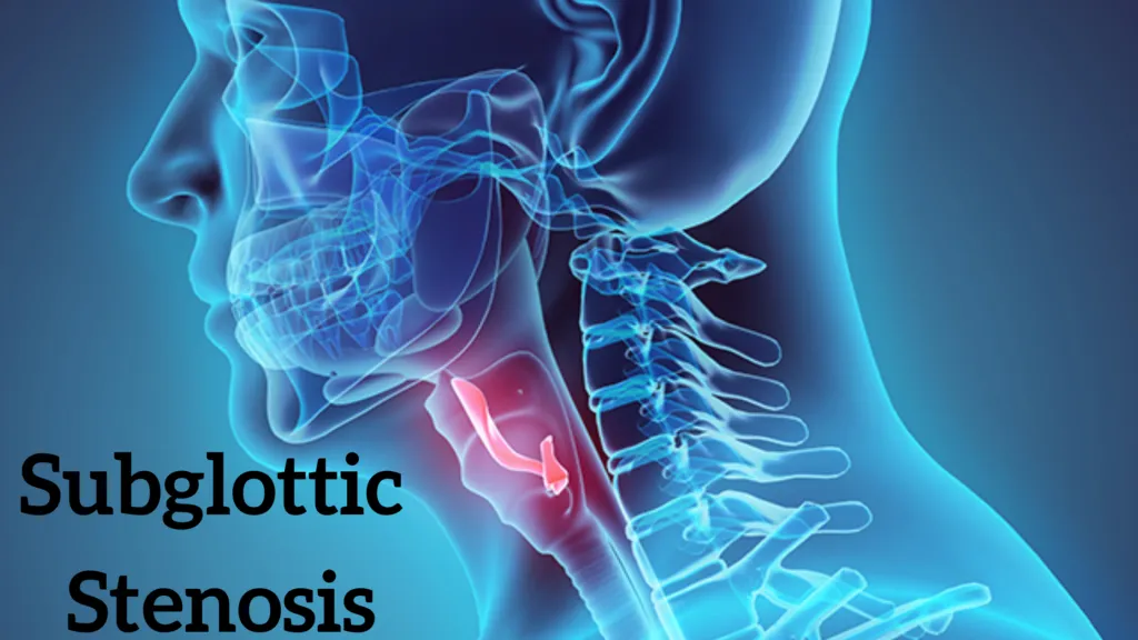 सबग्लॉटिक स्टेनोसिस (Subglottic Stenosis - श्वासनली के ऊपरी हिस्से का सिकुड़ना)