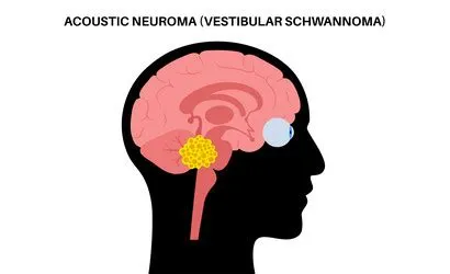 अकॉस्टिक न्यूरोमा (Acoustic Neuroma - सुनने की नस का ट्यूमर)