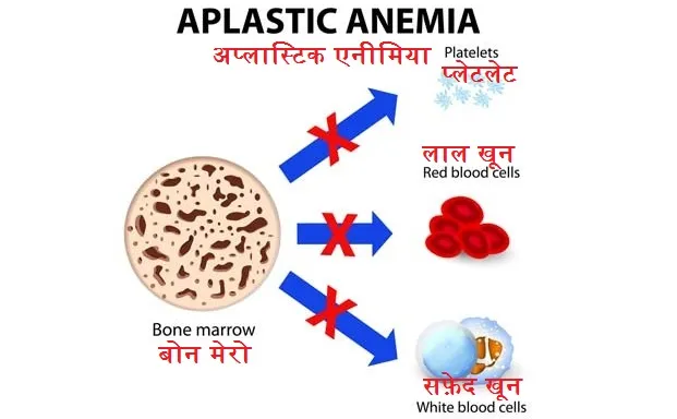 अप्लास्टिक एनीमिया (Aplastic Anemia)