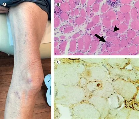 इंक्लूजन बॉडी मायोसिटिस (Inclusion Body Myositis)