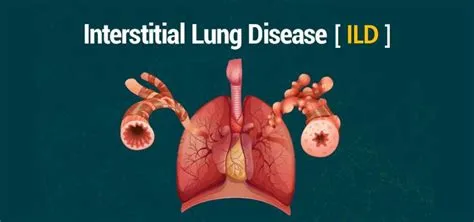 इंटरस्टिशियल लंग डिजीज (Interstitial Lung Disease - ILD)