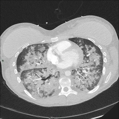 इडियोपैथिक पल्मोनरी हेमोसिडरोसिस (Idiopathic Pulmonary Hemosiderosis)