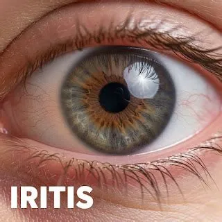 इराइटिस (Iritis - आंख के रंगीन हिस्से की सूजन)
