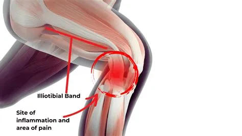 इलियोटिबियल बैंड सिंड्रोम (IT Band Syndrome)