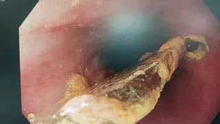 ईोसिनोफिलिक एसोफेगाइटिस (Eosinophilic Esophagitis - भोजन नली में एलर्जी)