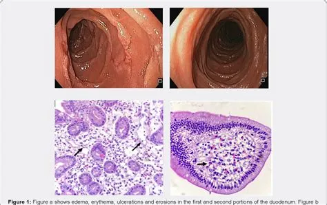 ईोसिनोफिलिक गैस्ट्रोएंटेराइटिस (Eosinophilic Gastroenteritis)