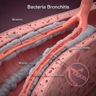 एक्यूट ब्रोंकाइटिस (Acute Bronchitis - छाती में तीव्र संक्रमण)