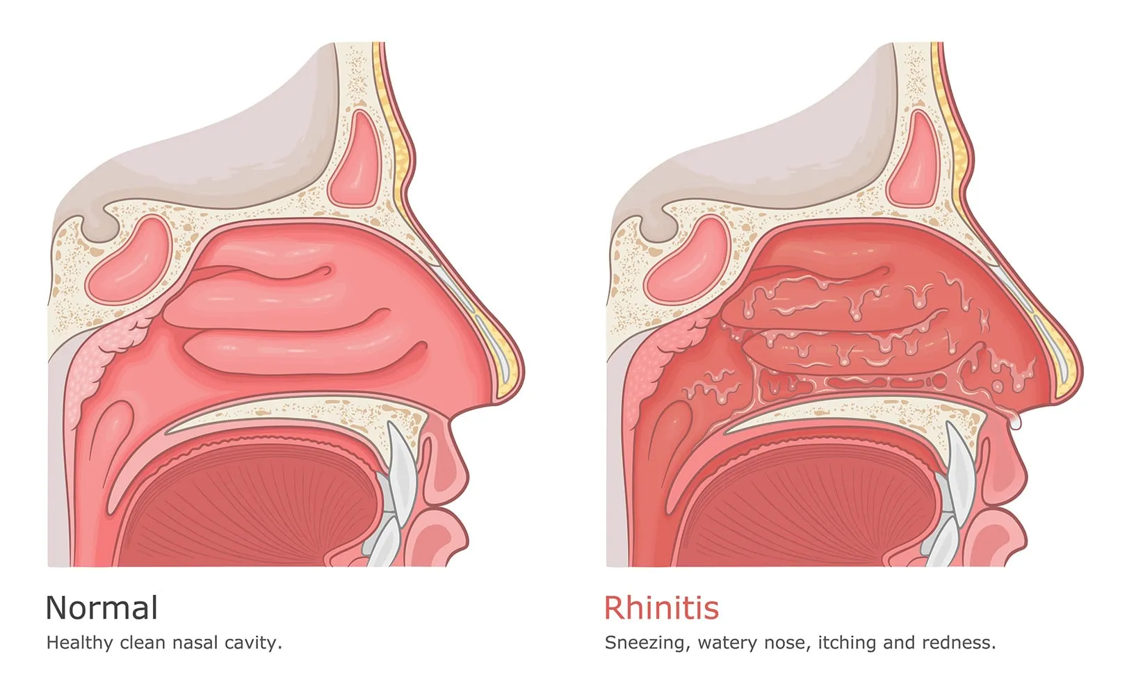 एट्रोफिक राइनाइटिस (Atrophic Rhinitis - नाक के अंदर की झिल्ली का सिकुड़ना)