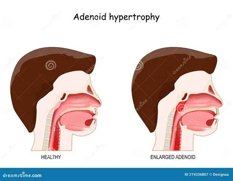 एडिनोइड हाइपरट्रॉफी (Adenoid Hypertrophy - बढ़े हुए एडिनोइड्स)
