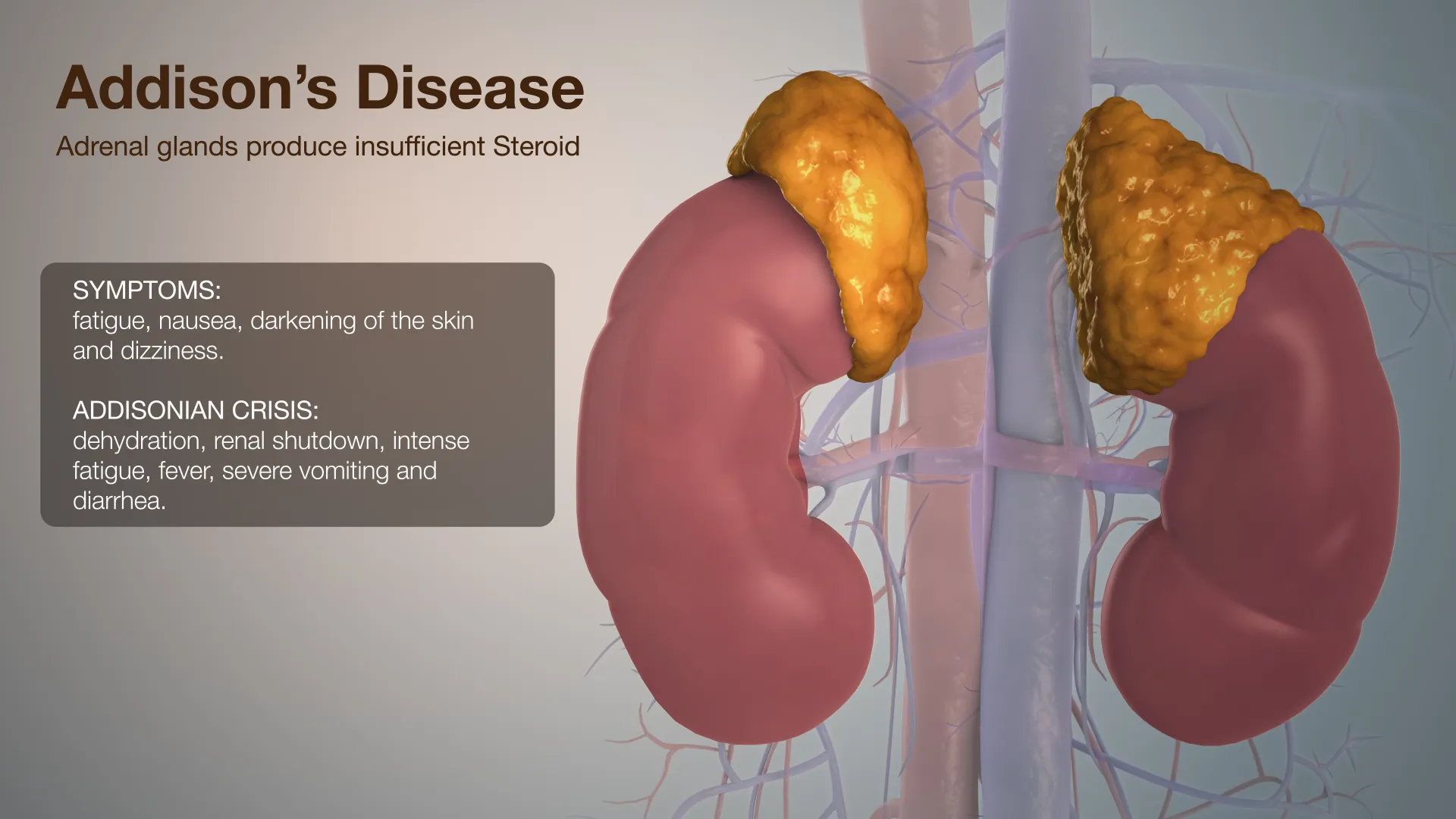 एडिसन रोग (Addison's Disease - एड्रेनल ग्रंथि की कमी)