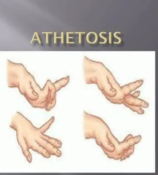 एथेटोसिस (Athetosis - धीमी और घुमावदार हलचल)