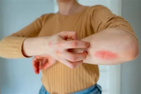 एनाफिलेक्सिस (Anaphylaxis - जानलेवा और गंभीर एलर्जिक रिएक्शन)