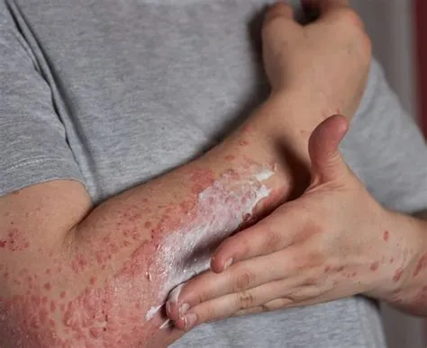 एपिडर्मोलिसिस बुलोसा (Epidermolysis Bullosa - नाजुक और छिलने वाली त्वचा)