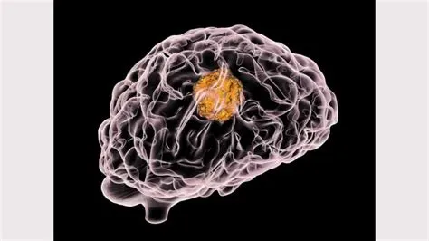एफेसिया (Aphasia - बोलने या समझने की क्षमता खोना)