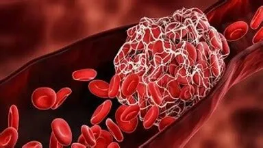 एमाइलॉयडोसिस (Amyloidosis - अंगों में असामान्य प्रोटीन का जमा होना)