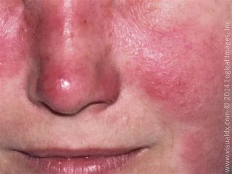 एरिथेमा नोडोसम (Erythema Nodosum - पैरों के निचले हिस्से में लाल और दर्दनाक गांठें)
