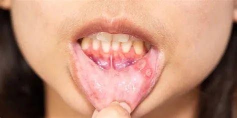 एरिथ्रोप्लाकिया (Erythroplakia - मुंह में लाल धब्बे जो कैंसर बन सकते हैं)