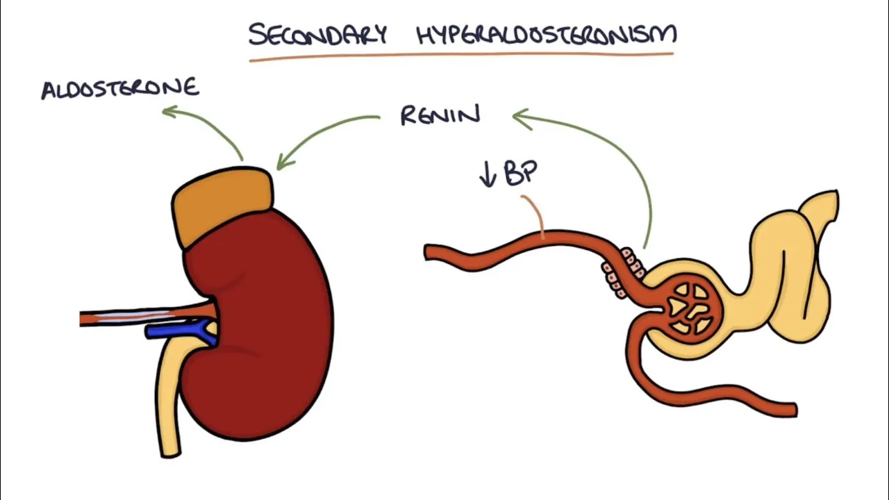एल्डोस्टेरोनिज़्म (Aldosteronism / Conn's Syndrome)