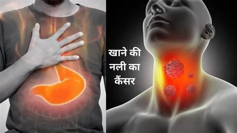 एसोफेजेल कैंसर (Esophageal Cancer - भोजन नली का कैंसर)