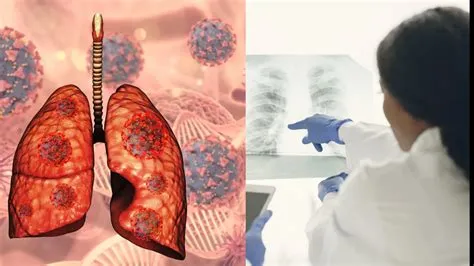 एस्पिरेशन निमोनिया (Aspiration Pneumonia - भोजन या तरल पदार्थ फेफड़ों में जाने से संक्रमण)