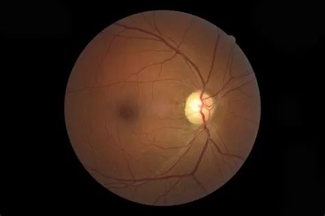 ऑप्टिक न्यूरोपैथी (Optic Neuropathy - आंख की नस का डैमेज होना)