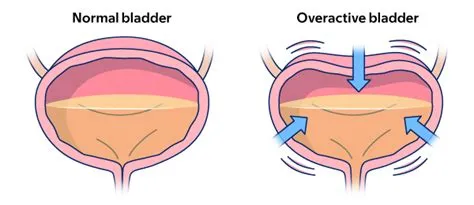ओवरएक्टिव ब्लैडर (Overactive Bladder - OAB - बार-बार पेशाब आना)