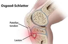 ओस्गूड-श्लाटर रोग (Osgood-Schlatter Disease - किशोरों में घुटने का दर्द)