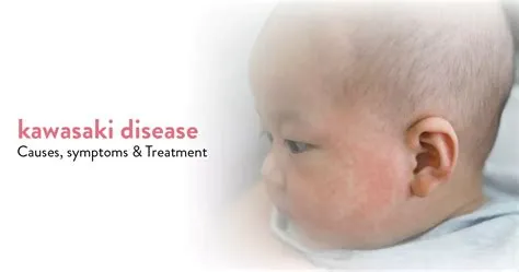 कवासाकी रोग (Kawasaki disease)